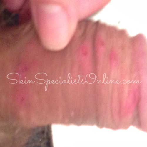 Scabs On My Penis 5